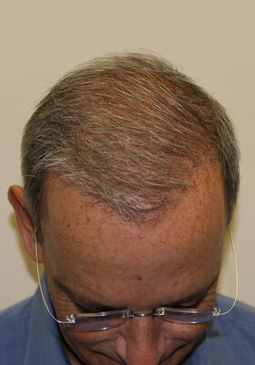 hair transplant photos