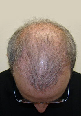 hair transplant before after Photos