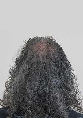 hair transplant before after Photos
