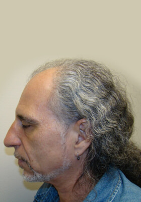 hair transplant before after Photos