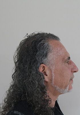 hair transplant photos