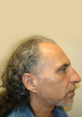 hair transplant photos