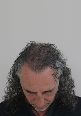 hair transplant photos