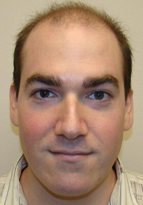 hair transplant before after Photos