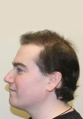 hair transplant photos