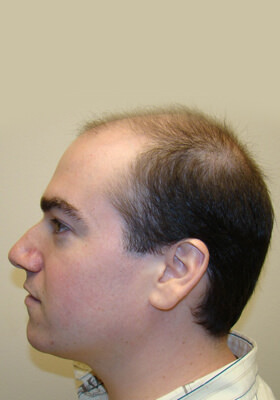 hair transplant before after Photos