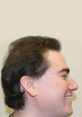 hair transplant photos