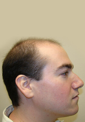 hair transplant photos