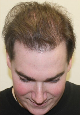 hair transplant photos