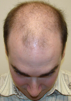 hair transplant photos