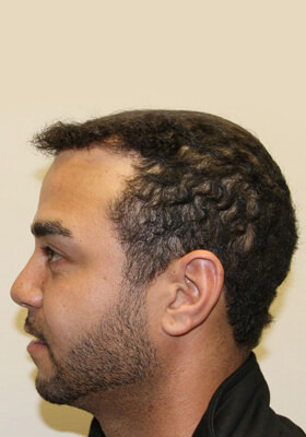 hair transplant before after Photos