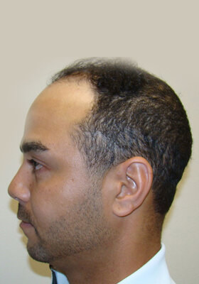 hair transplant before after Photos