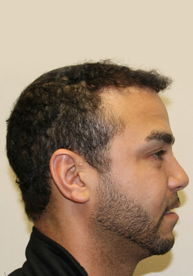 hair transplant before after Photos