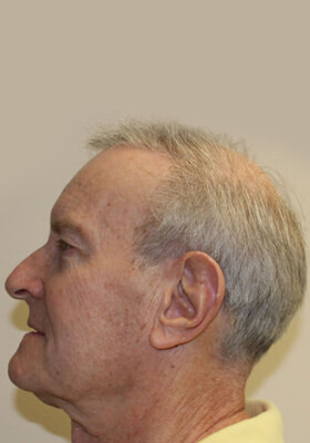 hair transplant photos