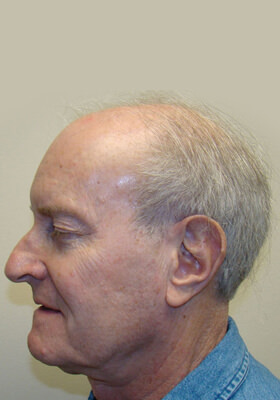 hair transplant before after Photos