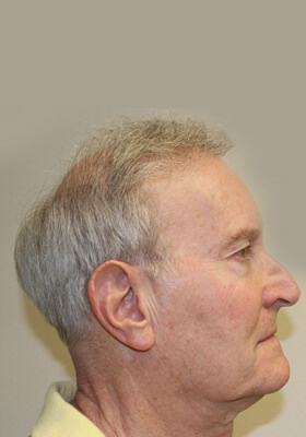 hair transplant photos