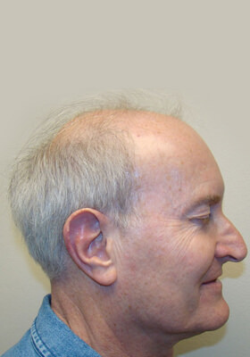 hair transplant before after Photos