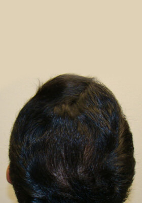 hair transplant before after Photos