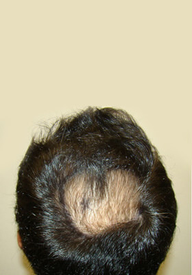 hair transplant before after Photos