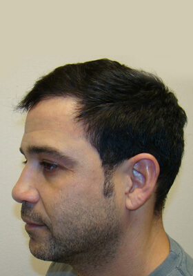 hair transplant photos