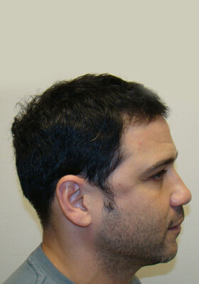 hair transplant photos