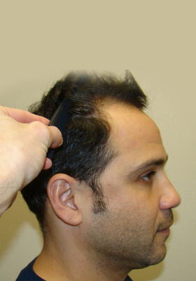 hair transplant before after Photos