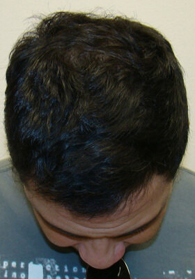 hair transplant photos