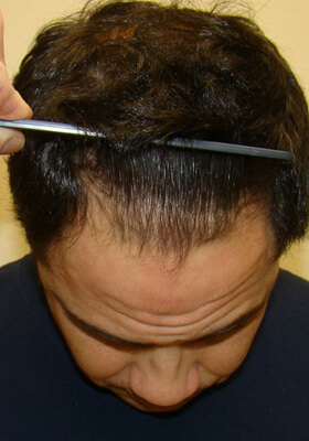 hair transplant photos