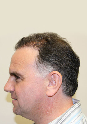 hair transplant before after Photos