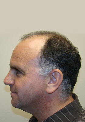 hair transplant before after Photos