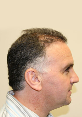 hair transplant before after Photos