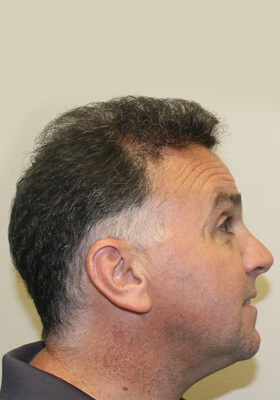 hair transplant photos