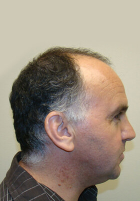 hair transplant photos