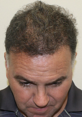 hair transplant before after Photos