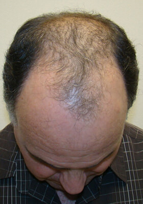 hair transplant photos