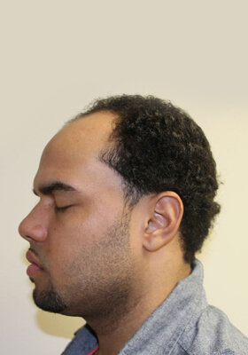 hair transplant photos