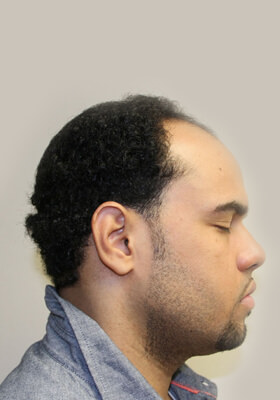 hair transplant before after Photos