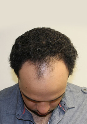 hair transplant photos