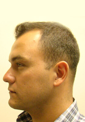 hair transplant before after Photos