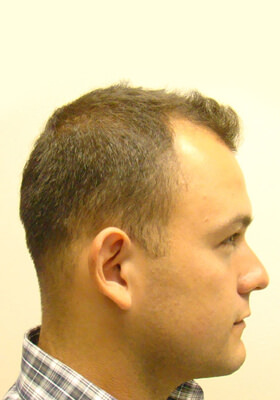 hair transplant before after Photos