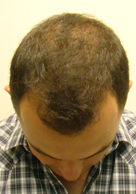 hair transplant photos