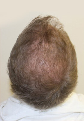 hair transplant photos