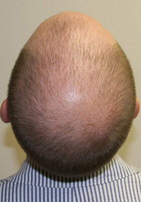 hair transplant photos