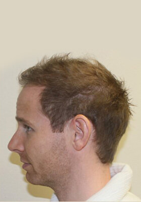 hair transplant photos