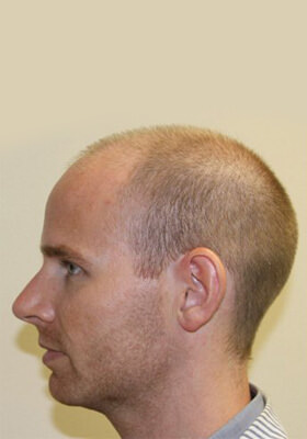 hair transplant photos