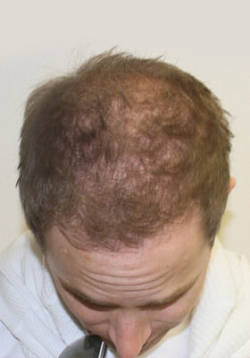 hair transplant before after Photos