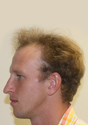 hair transplant photos