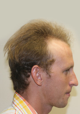 hair transplant before after Photos