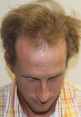 hair transplant photos