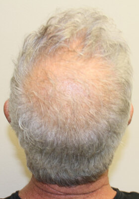 hair transplant photos